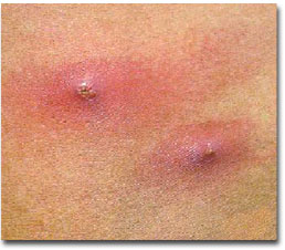 Essa infecção, pode-se originar em qualquer parte do corpo, exceto a palma da mão e na sola dos pés.